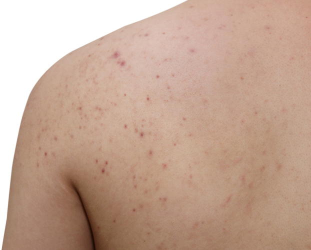 Điều Trị Mụn Lưng Tại Sen Beauty